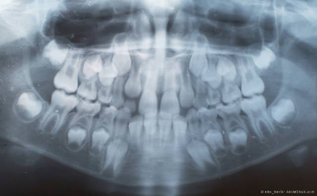 Röntgenaufnahme eines sog. Wechselgebisses.